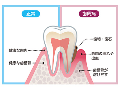 正常：健康な歯肉、健康な歯槽骨。歯周病：歯垢・歯石、歯肉の腫れや出血、歯槽骨が溶け出す