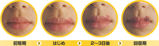 口唇ヘルぺスの主な症状