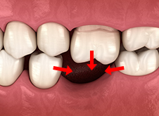 横の歯が抜けた方に傾いたり、上の歯が下に伸びたりして、噛み合わせのバランスが大幅に崩れてしまう！