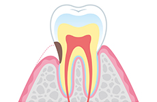 歯の根のむし歯