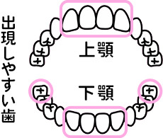 盲孔(もうこう)が出現しやすい歯