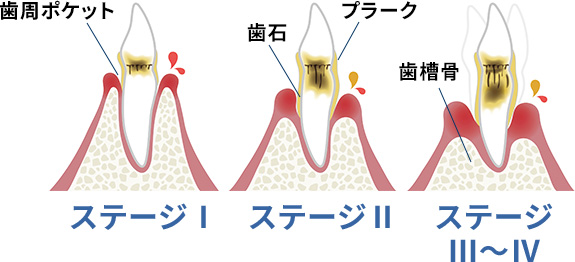 歯周病の進行ステージ。歯周ポケット、歯石、プラーク、歯槽骨の状態を示す図