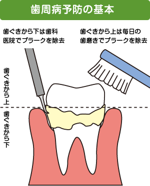 歯周病予防の基本